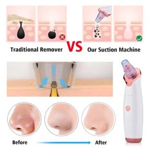 Electric Blackhead Remover demonstrating effective deep pore cleansing results, showing before and after comparison.